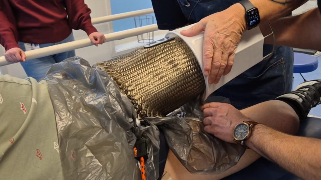 Op de stomp van een man met een bovenbeenamputatie wordt een koker gemaakt voor een beenprothese. De prothesekoker wordt volgens de techniek van direct socket gemaakt. In de fase op deze afbeelding zie je de basaltvezel mat om de amputatiestomp zitten en daaroverheen wordt een strakke siliconen hoes geschoven door twee prothesemakers om daarna op te vullen met een hars, zodat de stompkoker hard wordt.