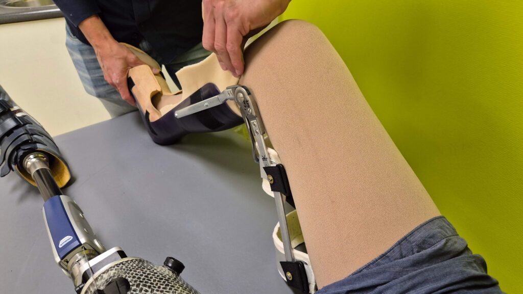 Afbeelding van hoe een orthopedisch instrumentmaker de Knie Enkel Voet Orthese om het verlamde rechterbeen van Ralph Stoové aanlegt. Ralph draagt links zijn bovenbeenprothese en om zijn rechterbeen ook een huidkleurige hoge therapeutische steunkous. De lange beenbeugel is deels opgebouwd uit kunststof voor het enkelvoetorthese-deel en uit aluminium strips voor de stevigheid en het bovenbeendeel.