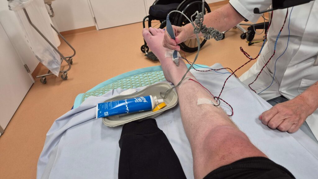Afbeelding van een verlamd rechterbeen waarbij een elektromyografisch onderzoek, oftewel een EMG, wordt uitgevoerd. Het linkerbeen is boven de knie geamputeerd. Je ziet een hand van de dokter die het apparaat bedient dat de stroomstootjes geeft om zenuwen en spieren te activeren in de zoektocht naar een spierziekte of neuropathie.