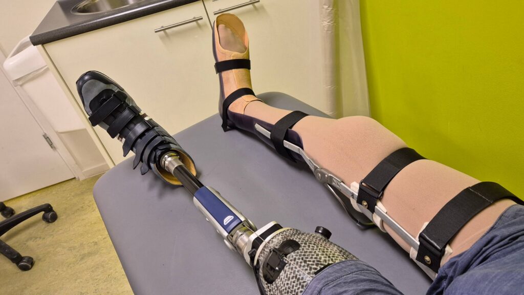 Foto van twee benen van een man die ligt op een behandeltafel bij ForMotion Orthopedie. De man draagt links een bovenbeenprothese en rechts heeft hij zojuist een knie enkel voet orthese aangelegd gekregen. Die lange beenbeugel is nog niet helemaal afgewerkt, omdat dit een proefpassing betreft. De beenspalk heeft door de man (Ralph Stoové) de naam 'Forest' gekregen, o.a. als verwijzing naar de film Forest Gump en Ralphs liefde voor bos en natuur. Forest de enkelvoetorthese wordt daarmee het vriendje van 'Murphy', zoals hij zijn beenprothese noemt.