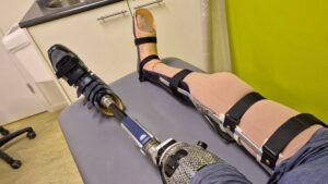 Foto van twee benen van een man die ligt op een behandeltafel bij ForMotion Orthopedie. De man draagt links een bovenbeenprothese en rechts heeft hij zojuist een knie enkel voet orthese aangelegd gekregen. Die lange beenbeugel is nog niet helemaal afgewerkt, omdat dit een proefpassing betreft. De beenspalk heeft door de man (Ralph Stoové) de naam 'Forest' gekregen, o.a. als verwijzing naar de film Forest Gump en Ralphs liefde voor bos en natuur. Forest de enkelvoetorthese wordt daarmee het vriendje van 'Murphy', zoals hij zijn beenprothese noemt.