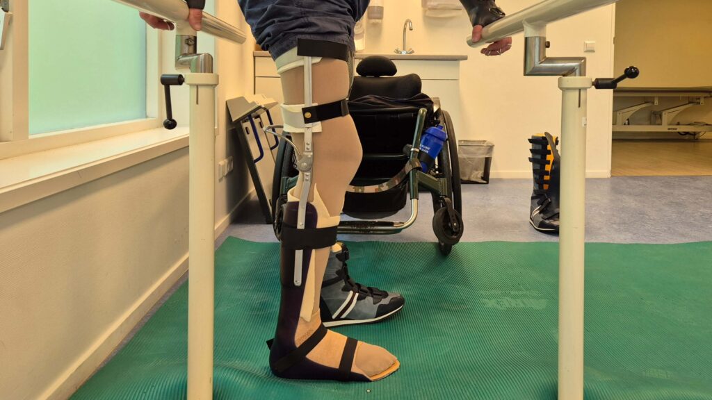 Zijaanzicht van het onderlijf van een man die links een bovenbeenprothese draagt ivm een bovenbeenamputatie en rechts een Knie Enkel Voet Orthese ivm een verlamd been. Je ziet dat het rechterbeen licht gebogen is, omdat die door de verlamming als het ware hangt in de beenspalk. De man staat in een brug die bij revalidatiecentra vaak gebruikt wordt. De knieenkelvoetorthese is opgebouwd uit kunststof voor het enkelvoetorthese-deel en uit aluminium strips en beugels voor de rest.